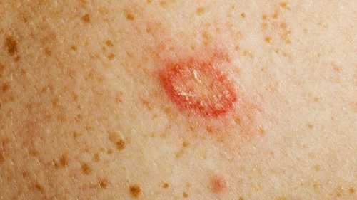 Стригущий лишай микроспория заразное кожное заболевание, которое вызывают паразитиче ские грибки и