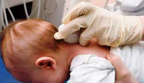 Гипоксия головного мозга у новорожденных