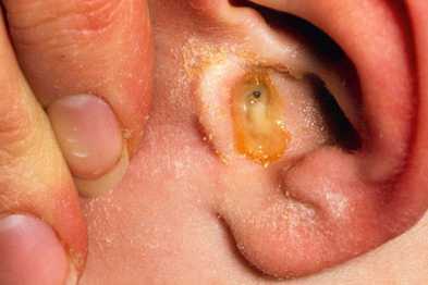 Хронический отит среднего уха подразделяется в зависимости от воспаления на два типа